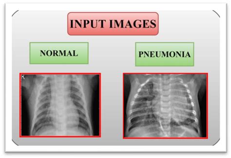 Pneumonia (PNA) .